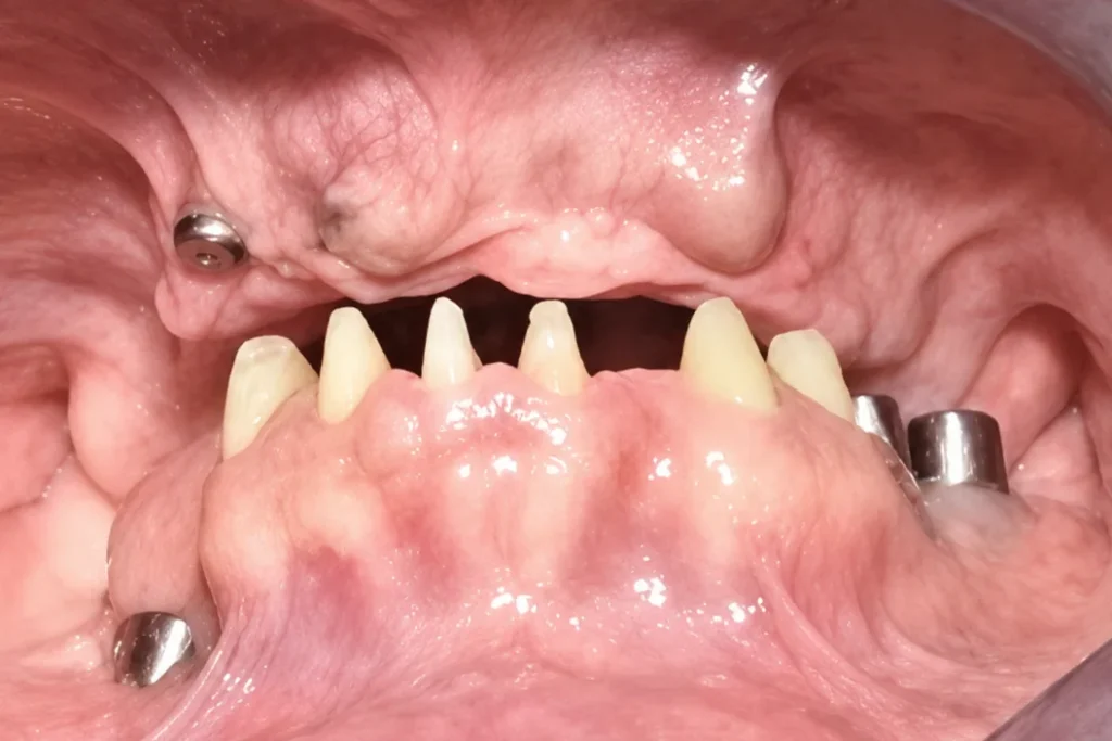 Komplikacija implantata pre revizione operacije