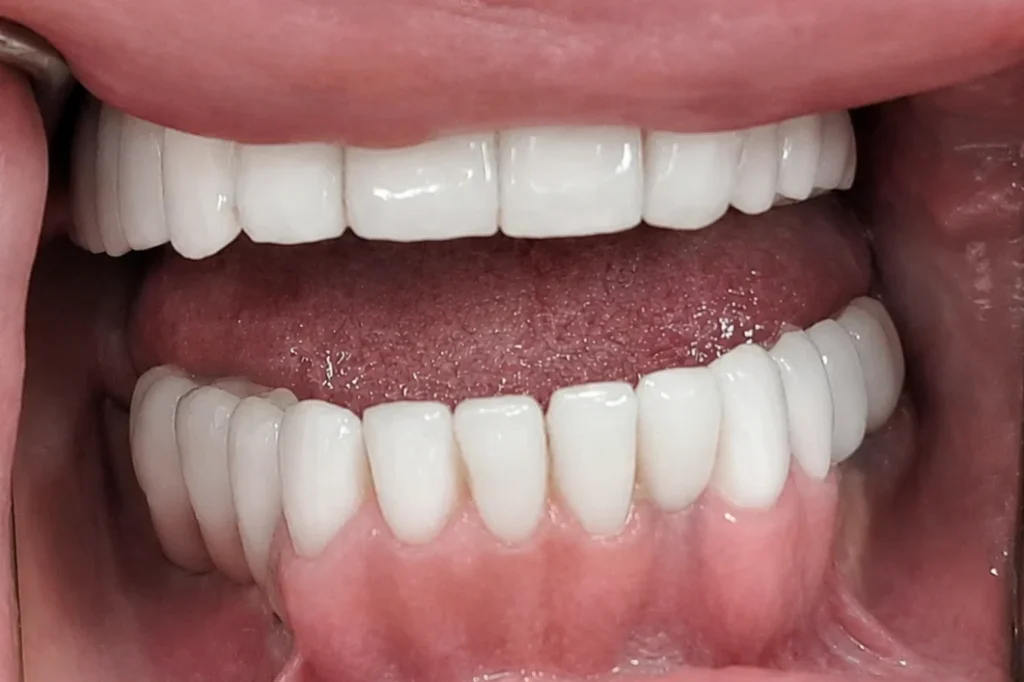 Konacan rezultat cirkon keramicke krunice i mostovi na implantatima