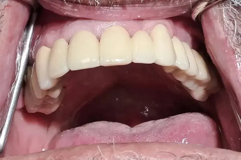 Metalokeramicki most na prirodnim zubima bez implanta gornja vilica