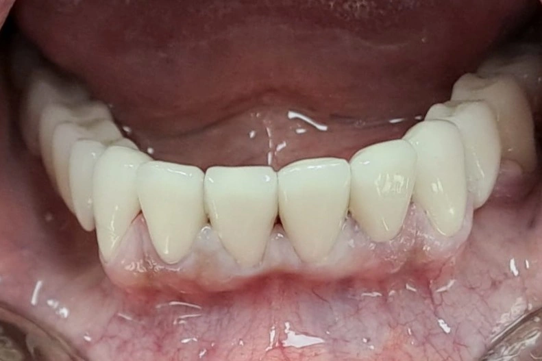 Most na implant i prirodnim zubima posle terapije