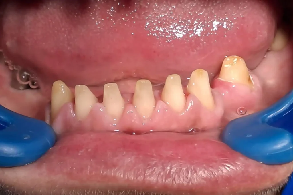 Most na implant i prirodnim zubima pre terapije