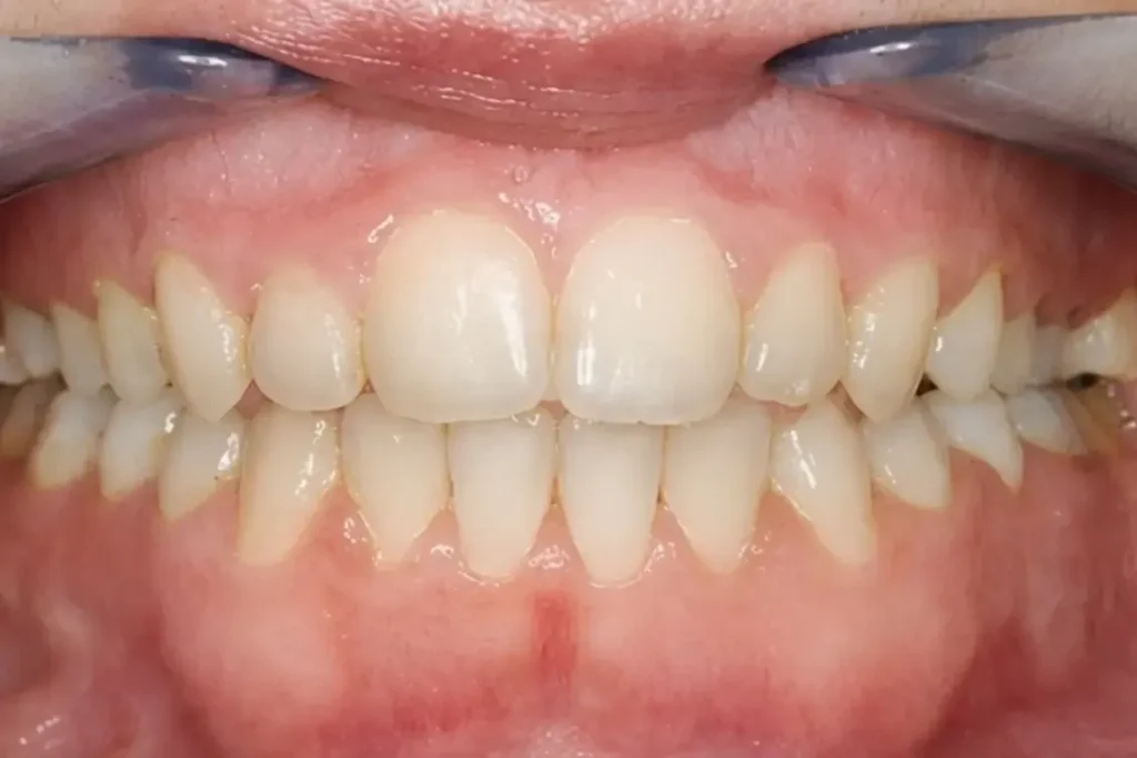 Nakon operacije vilice ortodontsko hirurska terapija - Hollywood Smile