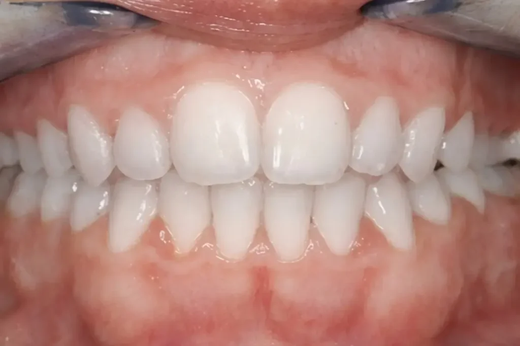 Posle ortodontsko hirurske terapije izbeljivanje zuba - Hollywood Smile