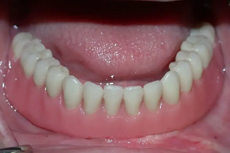 Proteza na 4 implantata sa preckom