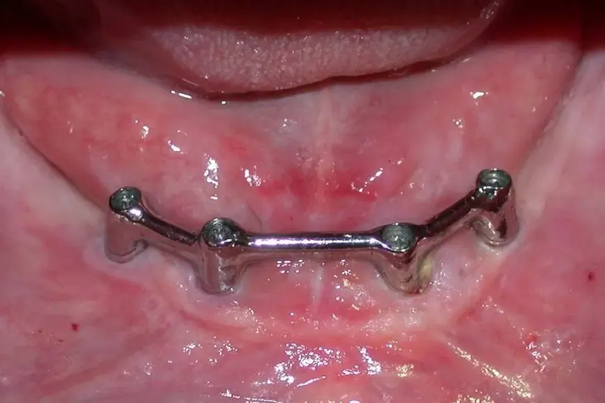 Proteza na 4 straumann implantata sa preckom