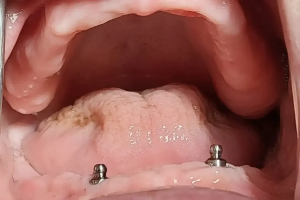 Proteza na dva implantata sa drikerima donja vilica