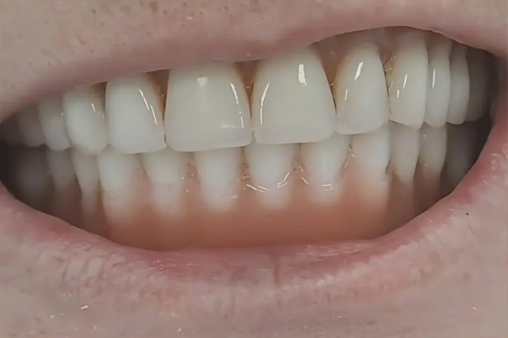 Rezultat proteza na dva implantata sa drikerima