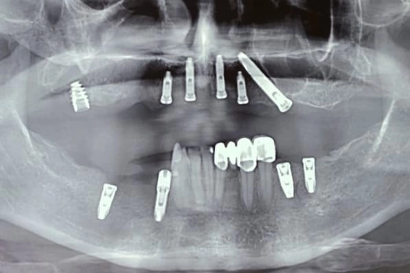 Rtg posle uklanjanja implantata i ugradnje novog implantata