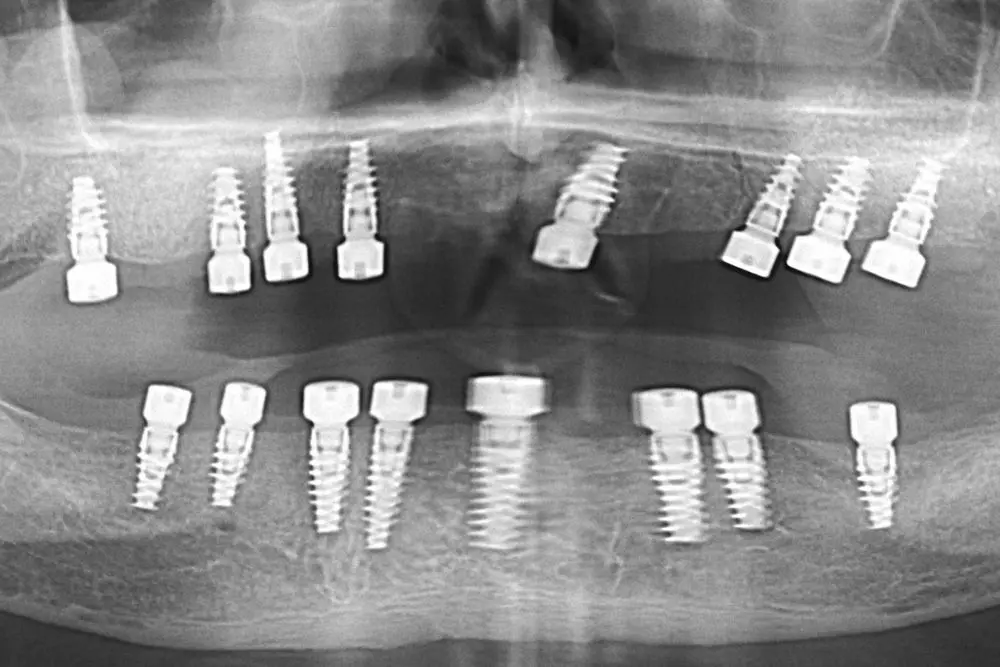 Totalna bezubost 16 dentalnih implantata 8 implantata po vilici