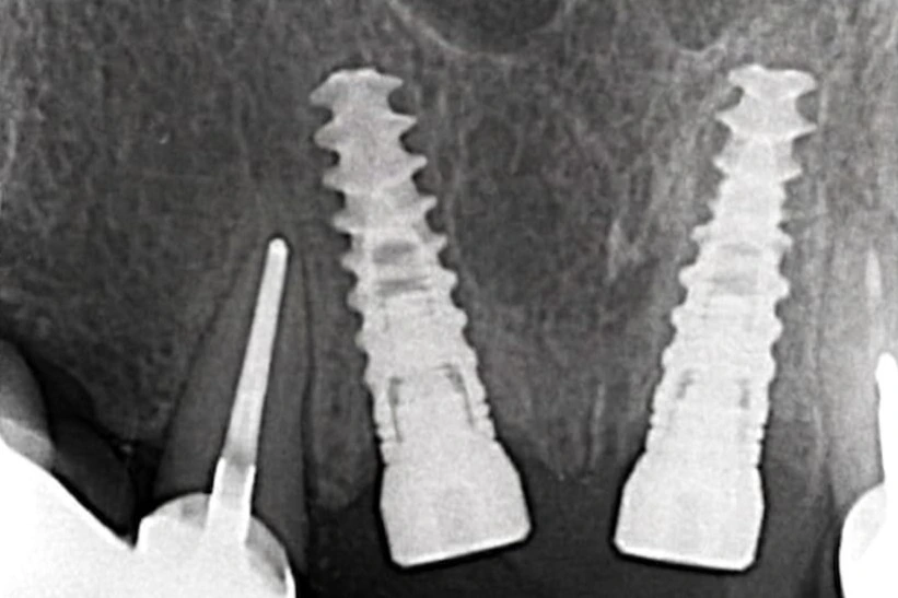 Ugradjena dva implantata u predelu jedinica