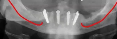 ALL ON 4 - cena i procedura - Dental implant expert