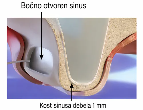 Bocno otvoren sinus lift - Dental Implant Expert