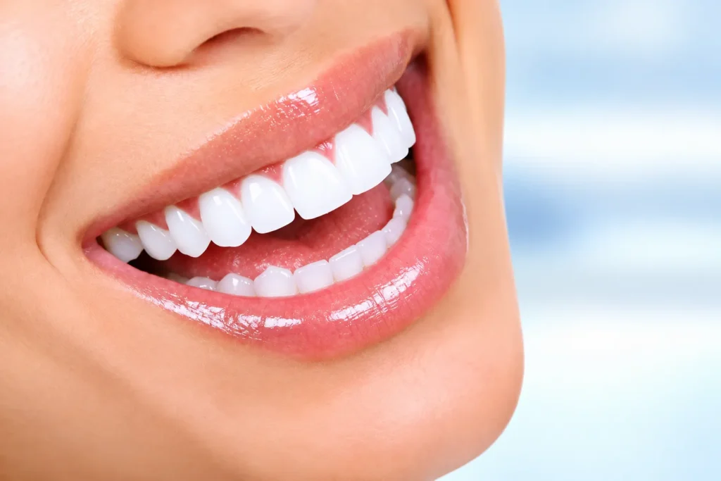 Hollywood Smile – rezultat estetske terapije zuba u ordinaciji Dental Implant Expert u Beogradu