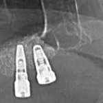 Implanti - Sinus lift i ugrađeni implanti