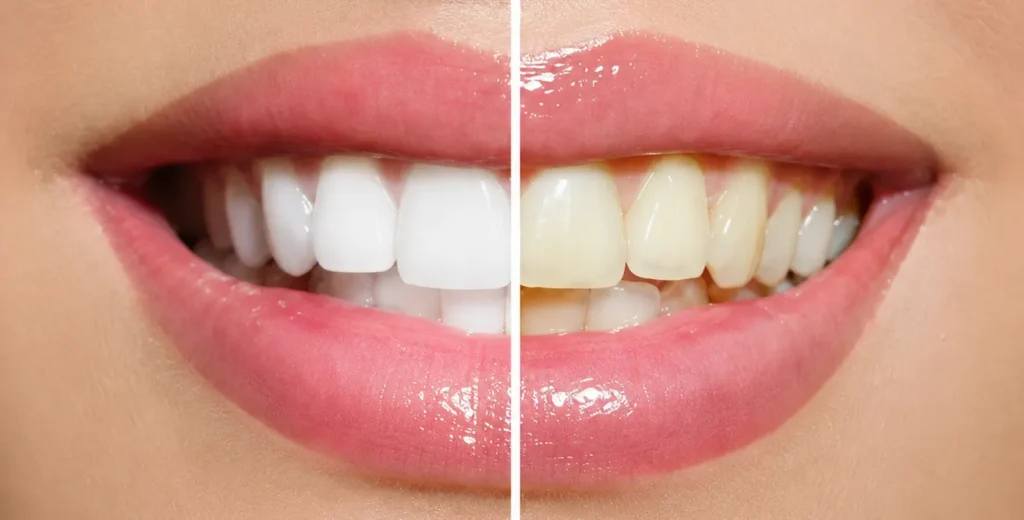 Metode za holivudski osmeh – izbeljivanje zuba, viniri i cirkonske krunice - Dental Implant Expert