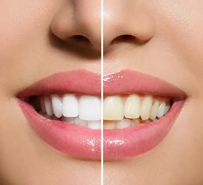 Izbeljivanje zuba kao metoda za holivudski osmeh - Dental Implant Expert