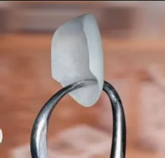 Keramički viniri postavljeni na prednje zube - Metoda za holivudski osmeh - Dental Implant Expert