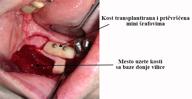 Koštani transplantat sa ugla donje vilice fiksiran mini-šrafovima