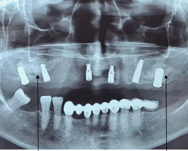 Istovremeno dodata veštačka kost i ugrađeni implantati u vilici - Nadogradnja vilične kosti - Dental Implant Expert