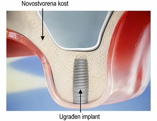 Novo stvorena kost - Ugradjen implant - Dental Implant Expert