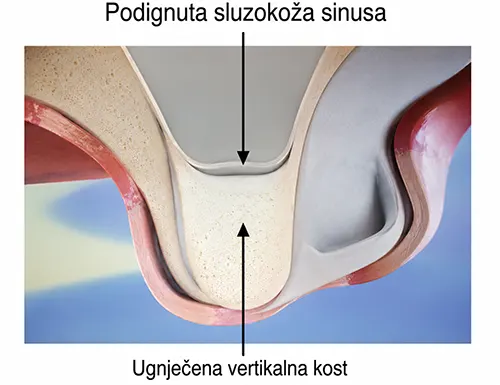 Podignuta sluzokoza sinusa - Dental Implant Expert