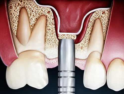 Podizanje poda sinus lifta - Dental Implant Expert