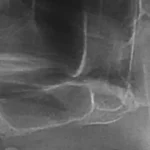 Sinus lift - rendgen kosti ispod sinusa