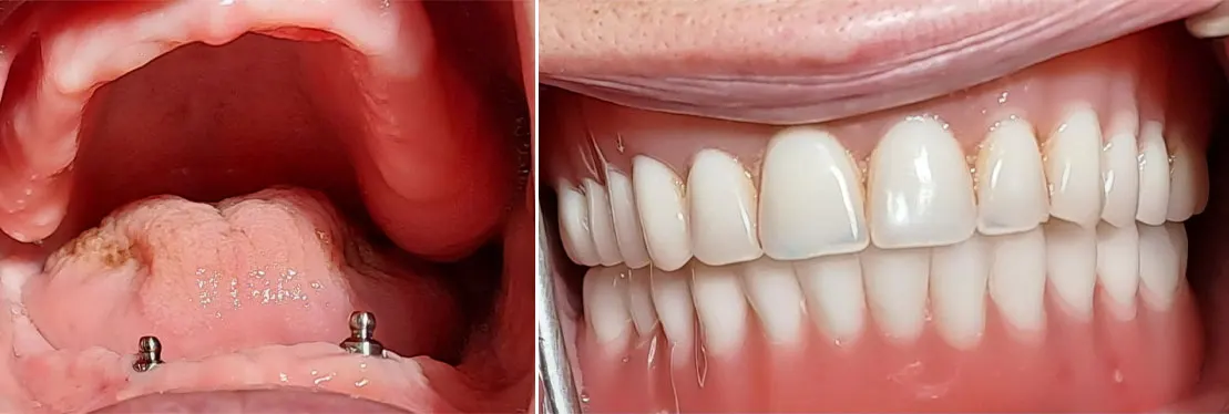 Ugradnja implanata u bezuboj vilici - Dental implant expert