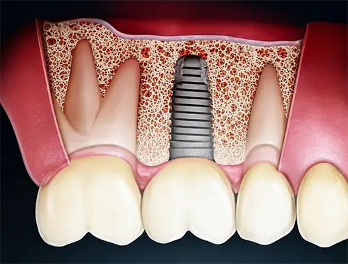 Ugradnja implanta nakon podizanja poda sinus lifta - Dental Implant Expert