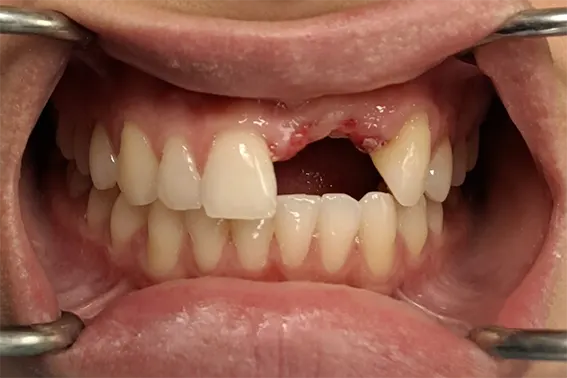 Kost uzeta sa ugla donje vilice za nadoknadu kosti pre ugradnje implantata