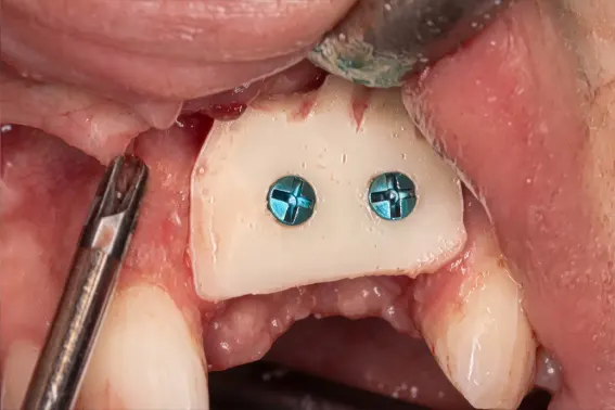 Kost uzeta sa ugla donje vilice za nadoknadu kosti pre ugradnje implantata