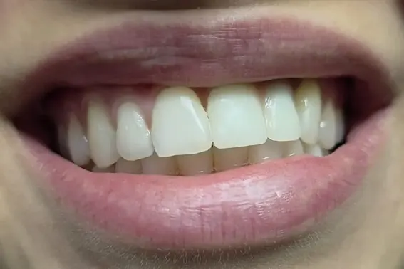 Osmeh posle uzete kosti sa ugla donje vilice za nadoknadu kosti pre ugradnje implantata