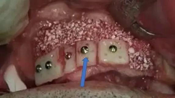 Autotransplantat koštanog bloka sa kuka pričvršćen istovremeno ugrađenim dentalnim implantatom u donjoj vilici