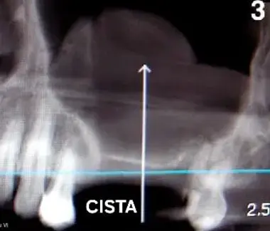 rentgenski snimak ciste u sinusu i prikaz pre/posle zahvata