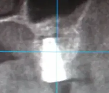 istovremeno izvadjena cista iz sinusa dodata vestacka kost i ugradjeni implant