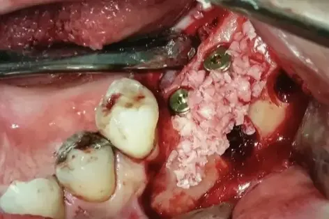 Koštana platforma metoda prof. dr Zorana Stajčića - nanošenje vještačke kosti preko dijela implantata izvan kosti