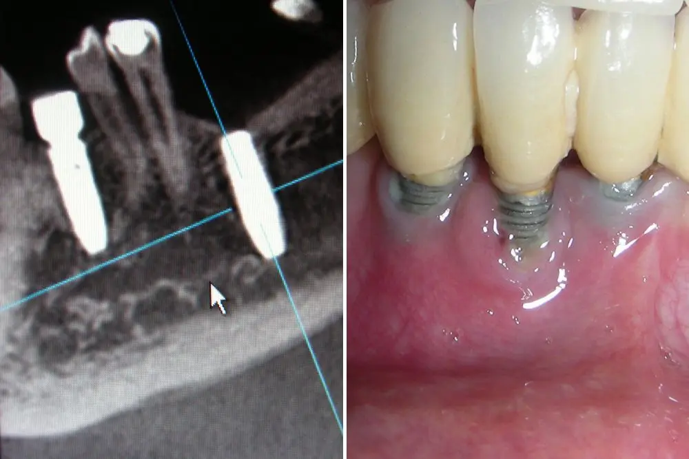 Periimplantitis – CBCT snimak gubitka kosti oko implanta i klinički nalaz upaljene desni sa ogoljenim navojima implanta
