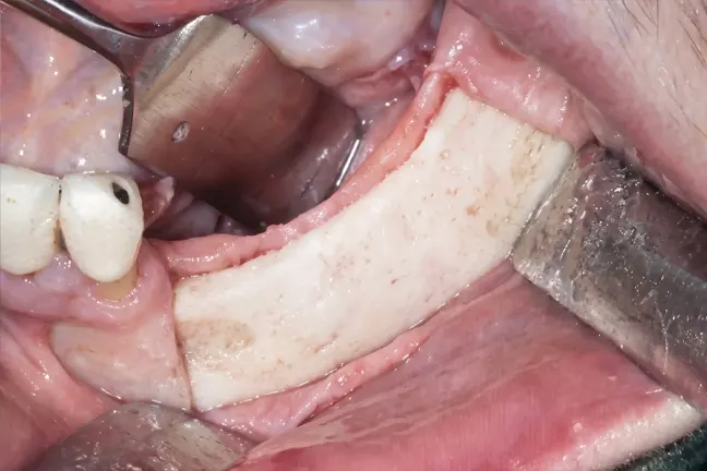 proširivana vilična kost sa tri ugrađena implantata