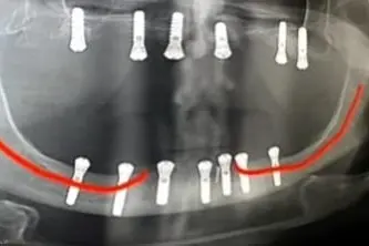 RTG snimak implantata, lateralizacija na modelu i video pacijentkinje