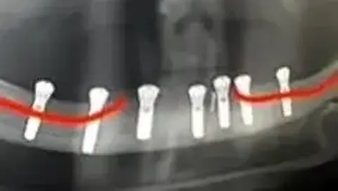 Postoperativni rentgenski snimak sa uspešno postavljenim implantatima kroz kanal donjoviličnog živca