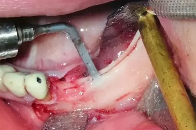 Proširena vilična kost sa tri ugrađena implantata posle piezoelektrične tehnike