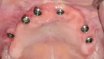 Potpuno formiran i zarastao vilični greben sa stabilno integrisanim dentalnim implantatima nakon transplantacije kosti sa kuka