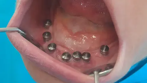 Ugrađeni zubni implantati sa gingiva formerima u donjoj vilici nakon transpozicije donjoviličnog živca