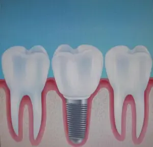 Jedan Alpha Bio implant sa metalokeramičkom krunicom – cena 550 €