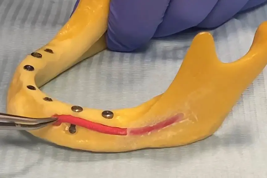 3D model donje vilice sa pomerenim mandibularnim živcem i ugrađenim implantima