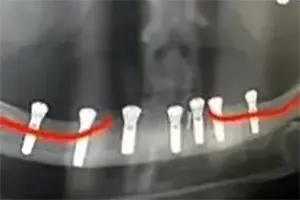 Panoramski rendgenski snimak implantata u donjoj vilici posle transpozicije živca